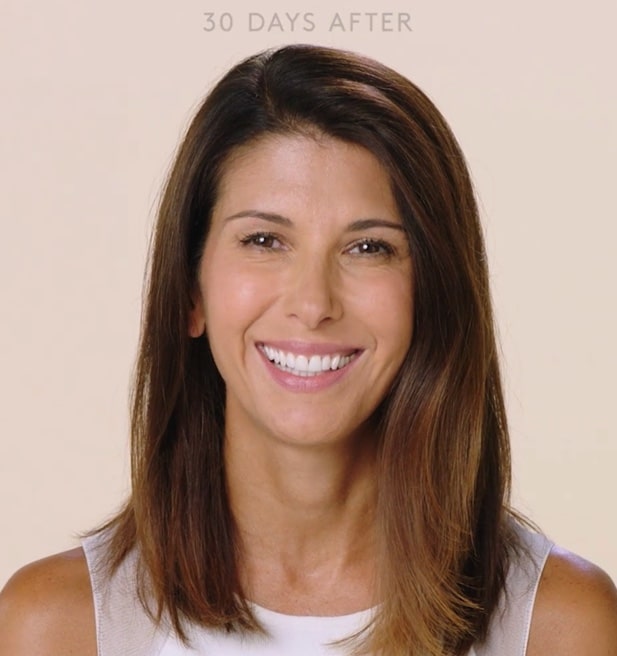 after botox treatment