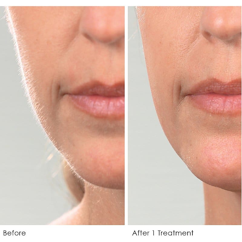 Dermaplaning