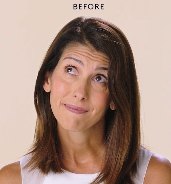 botox before and after